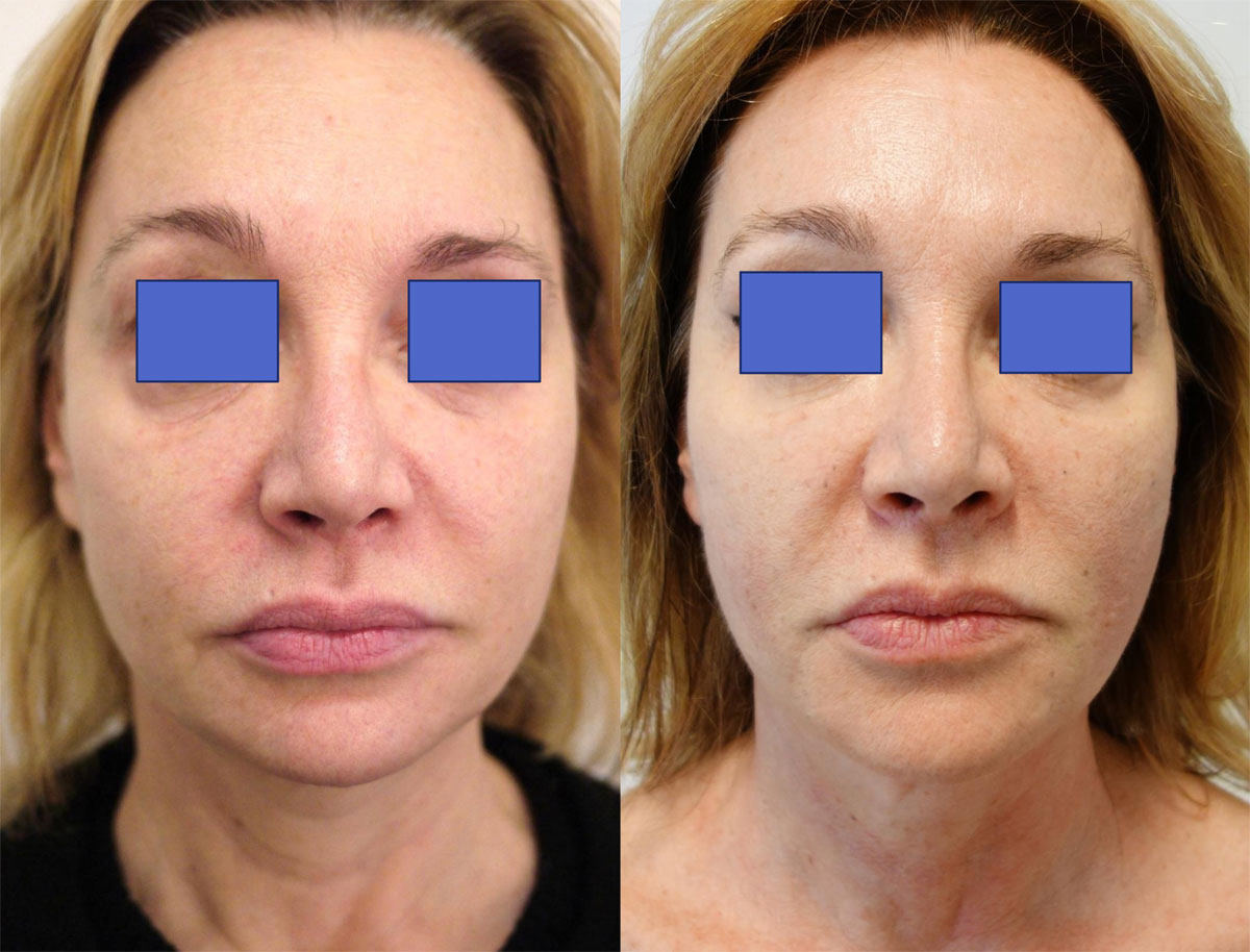 СМАС-лифтинг лица фото до и после процедуры | Фрау Марта
